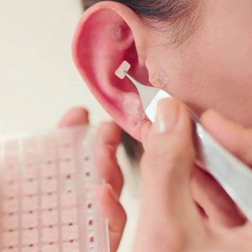 tratamento-auriculoterapia-sementes